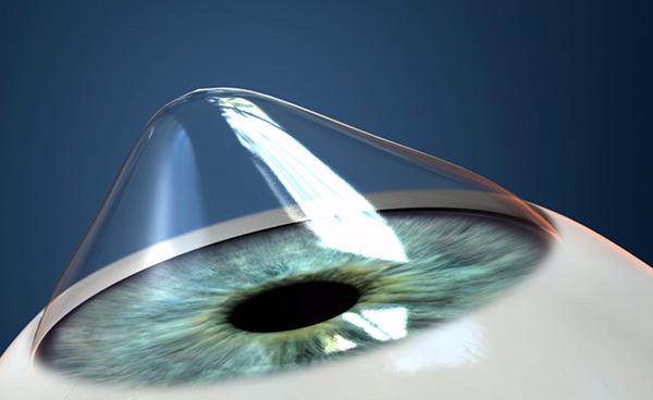 Keratoconus