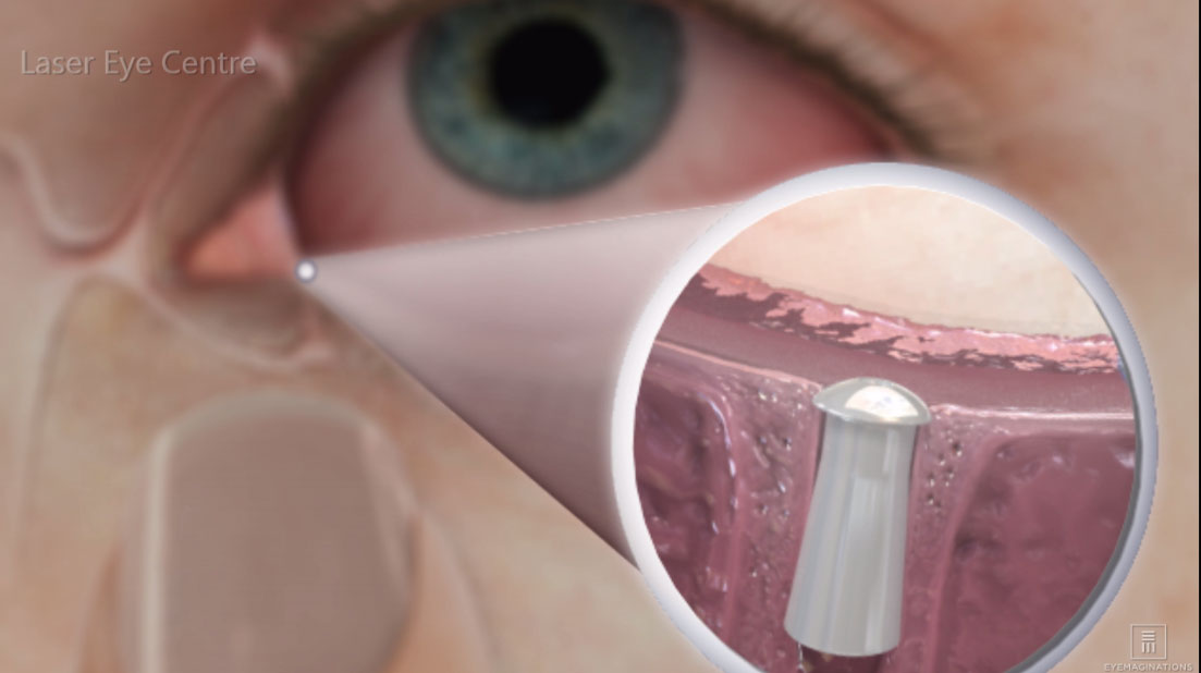 Ocular Surface Disorder – Laser Eye Centre Ltd